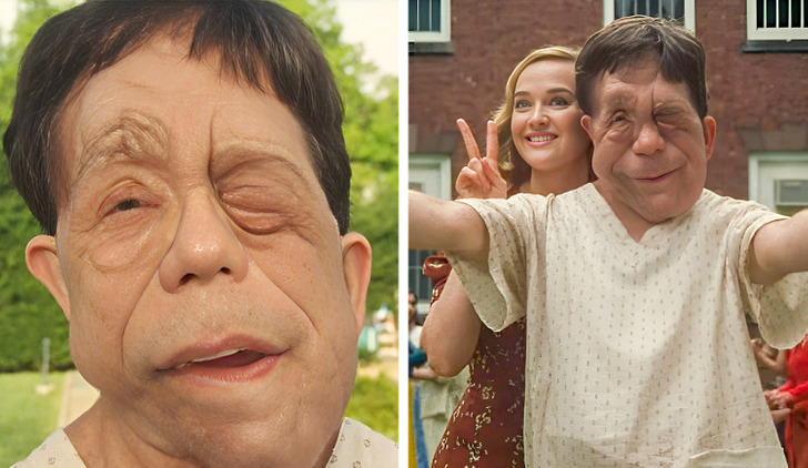 #4 | How Adam Pearson Melted The Hearts Of Fans (and Scarlett Johansson) | Zestradar