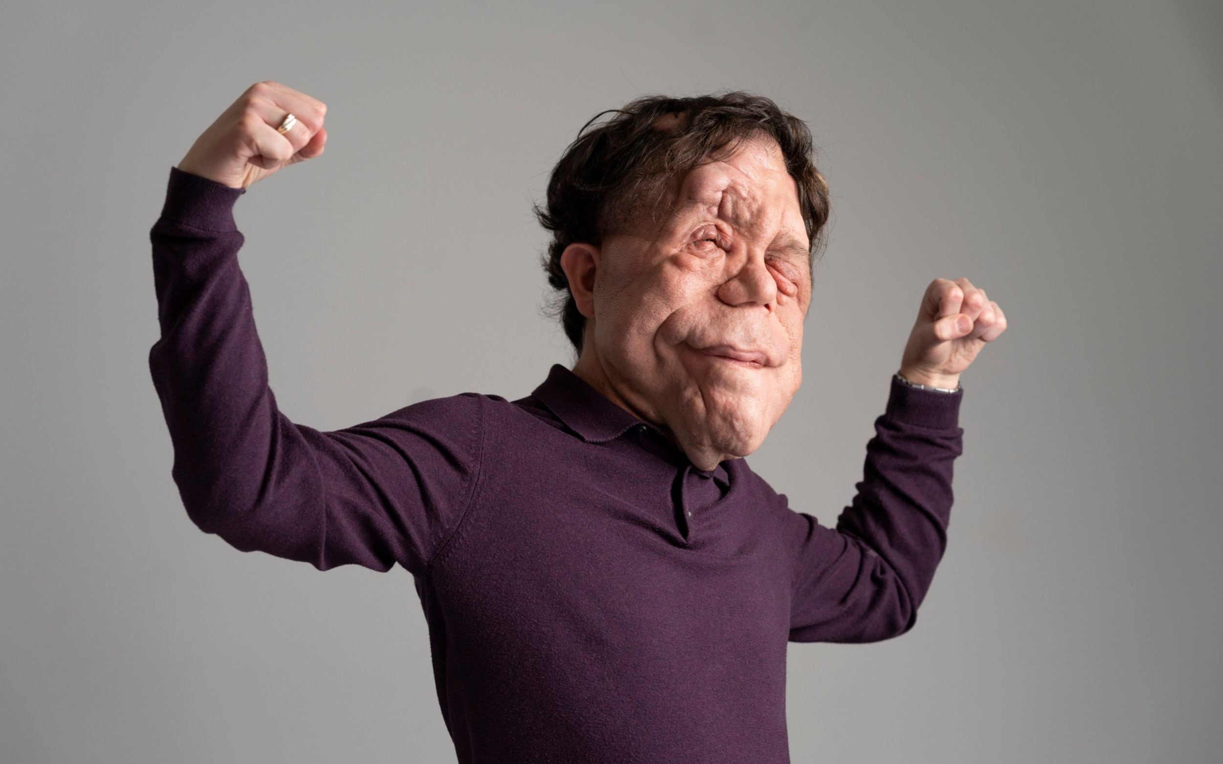 #7 | How Adam Pearson Melted The Hearts Of Fans (and Scarlett Johansson) | Zestradar