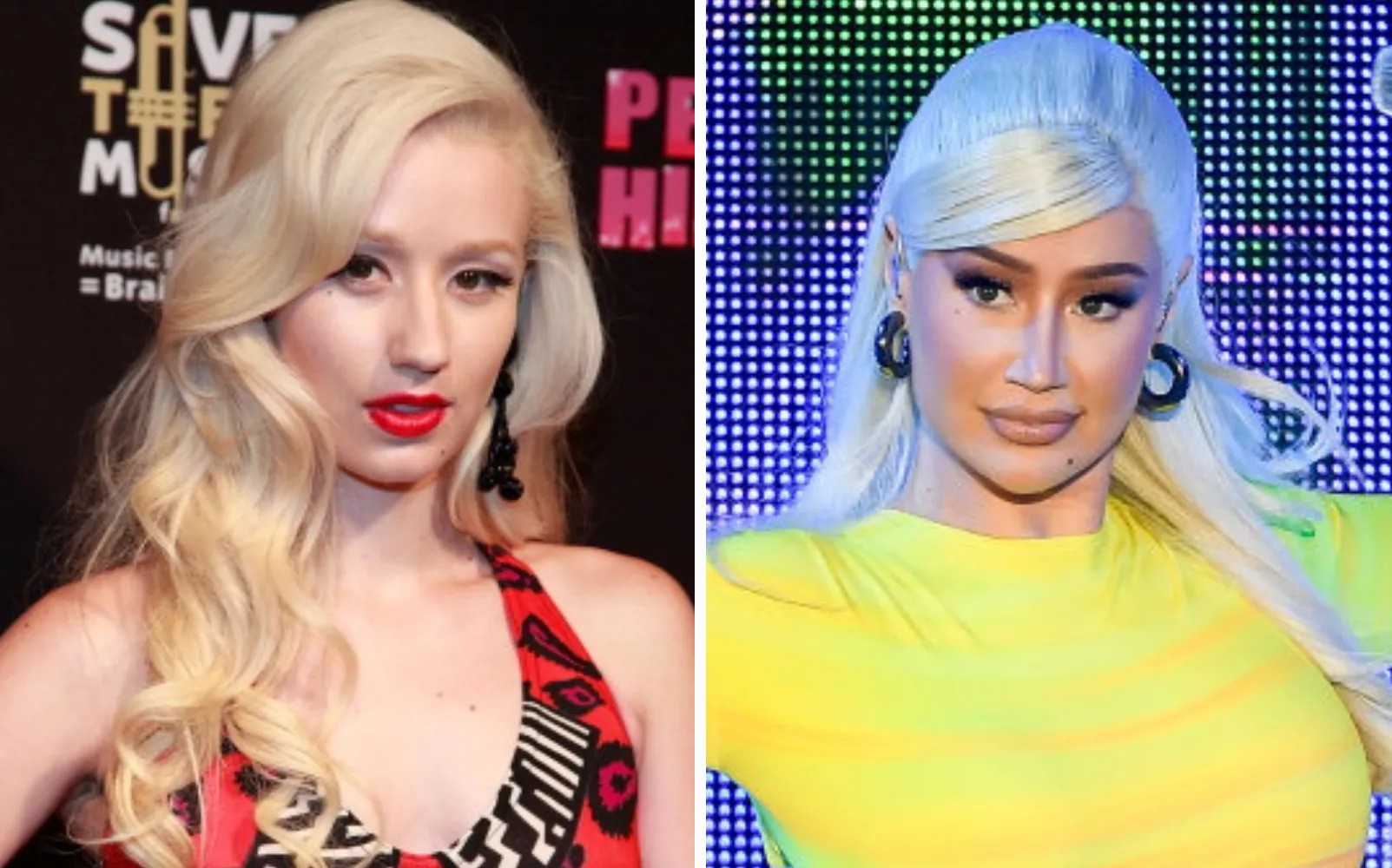 Iggy Azalea | 15 Celebs Who Openly Admit to Going Under the Knife | Zestradar