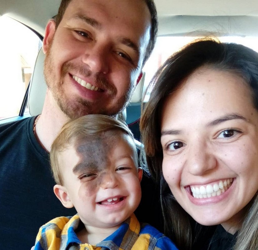 Celebrating Identity: Mother Adopts Son’s Birthmark on Her Face to ...