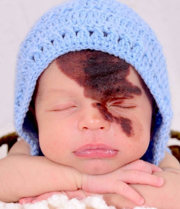 #4 | Woman Paints a Replica of Her Son’s Birthmark on Her Face to Celebrate His Uniqueness | Zestradar