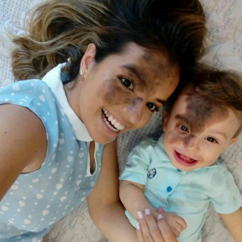#8 | Woman Paints a Replica of Her Son’s Birthmark on Her Face to Celebrate His Uniqueness | Zestradar
